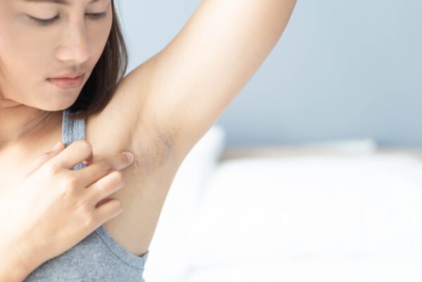 Warts Removal - Image 4