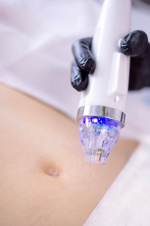 RF Microneedling & Exosomes - Image 7