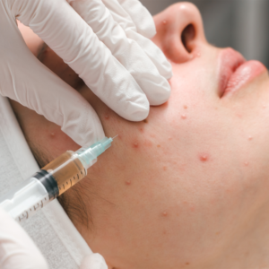 ANTI Acne & Keloids