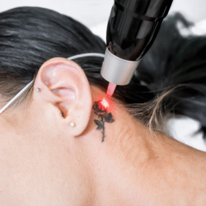 Tattoo Removal