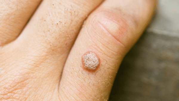 Warts Removal - Image 7
