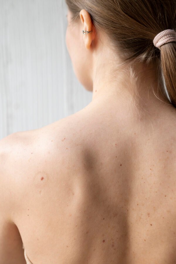 Warts Removal - Image 5